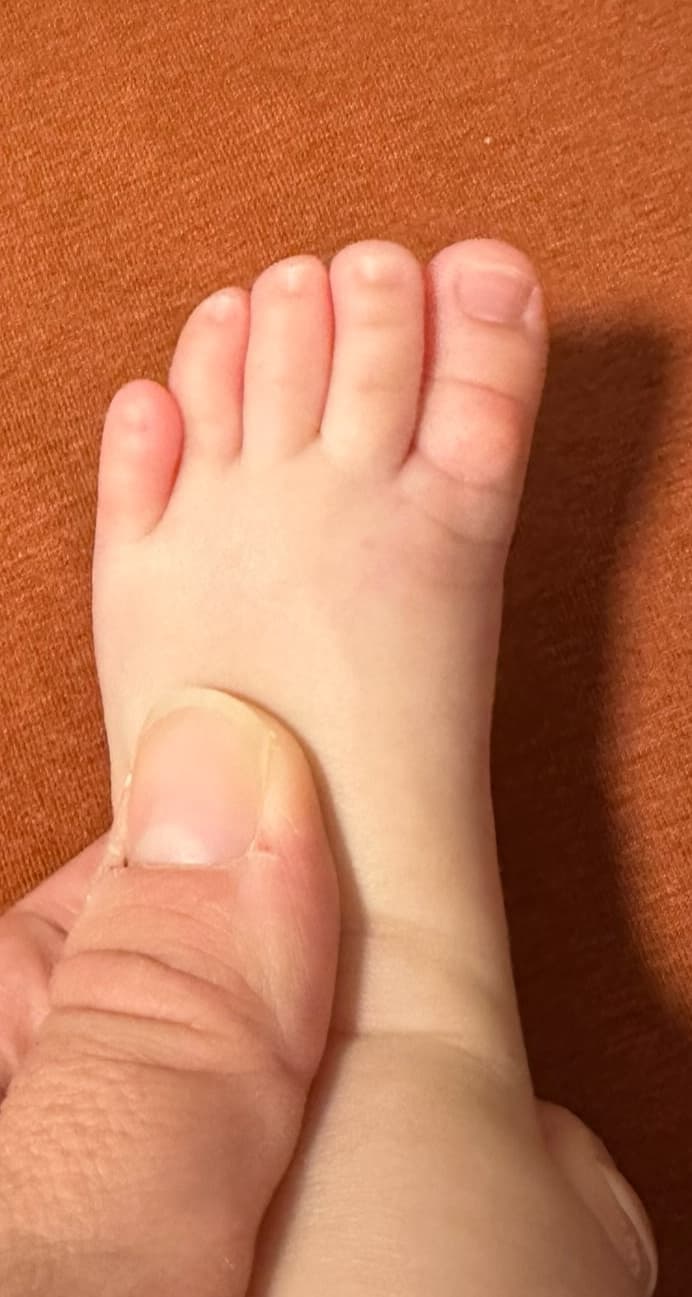 Effet du taping après 4 jours