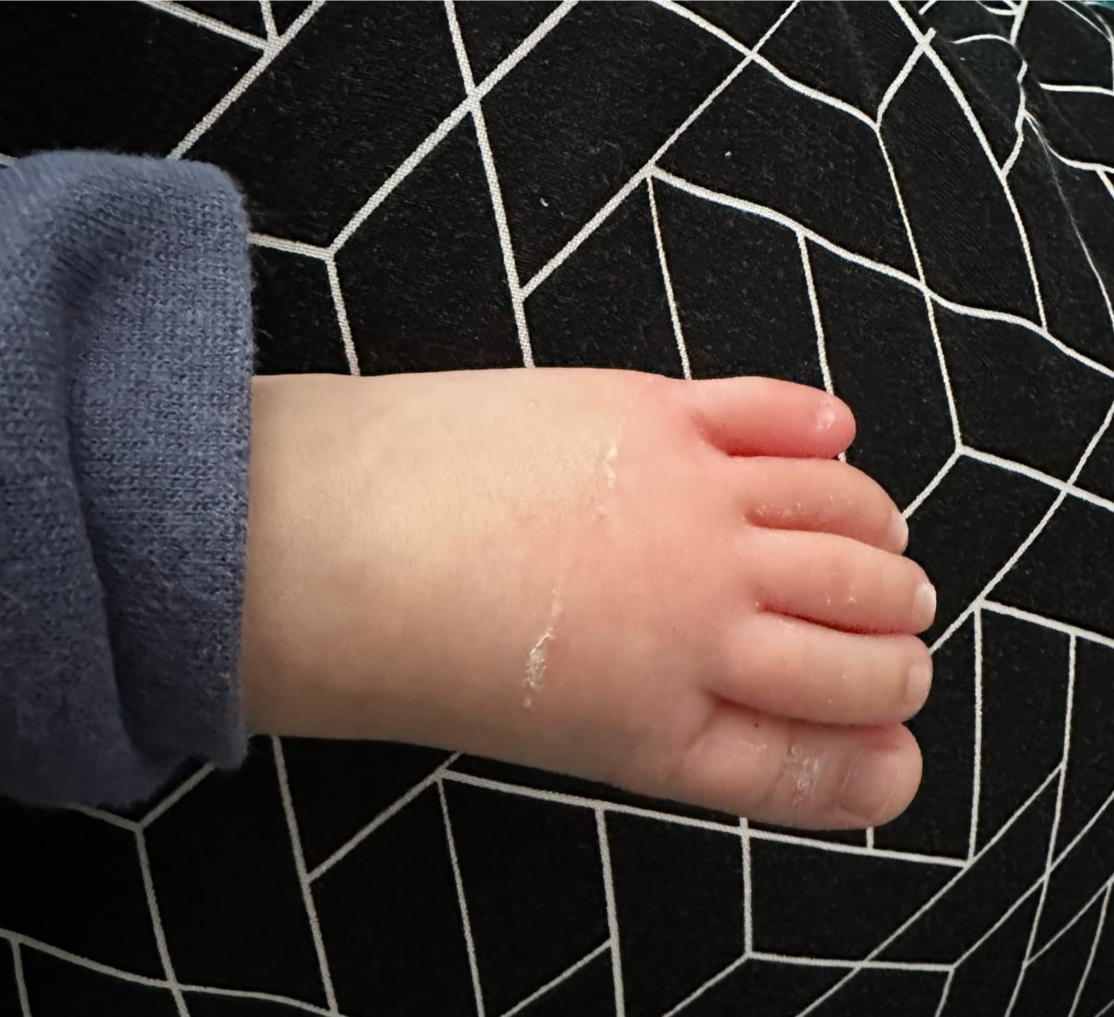 Effet du taping après 7 jours