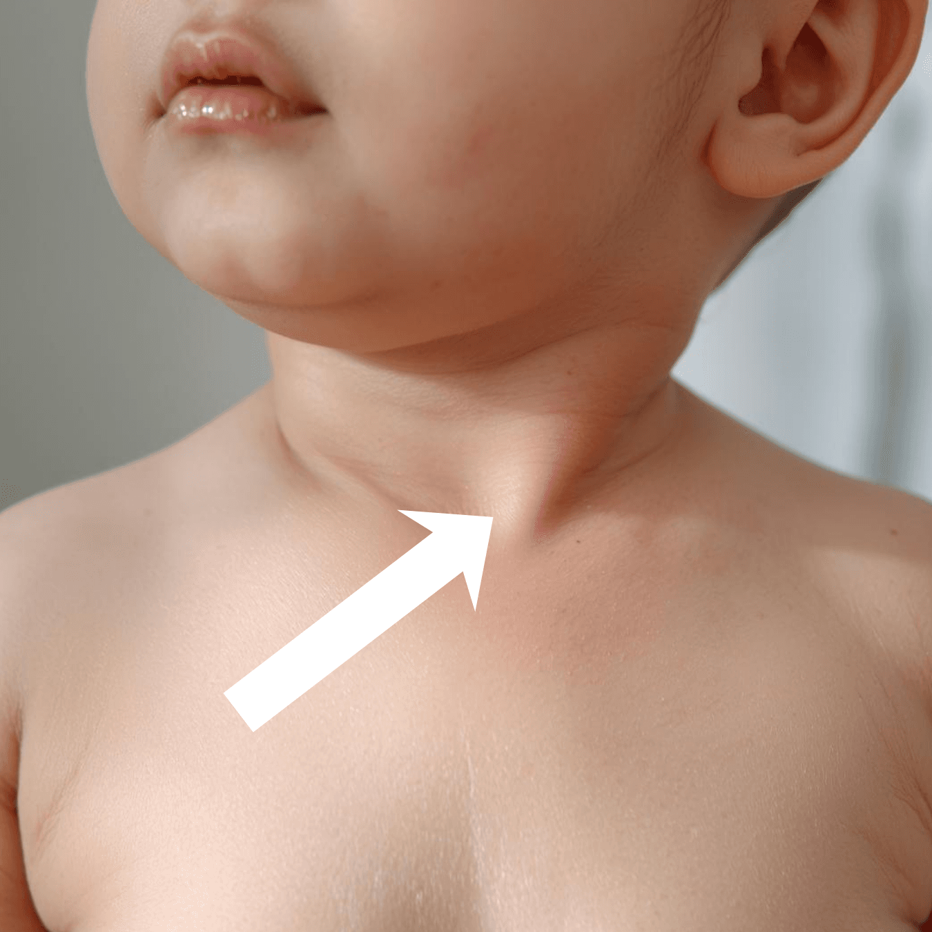 Bébé vu de dos montrant le muscle sternocléidomastoïdien