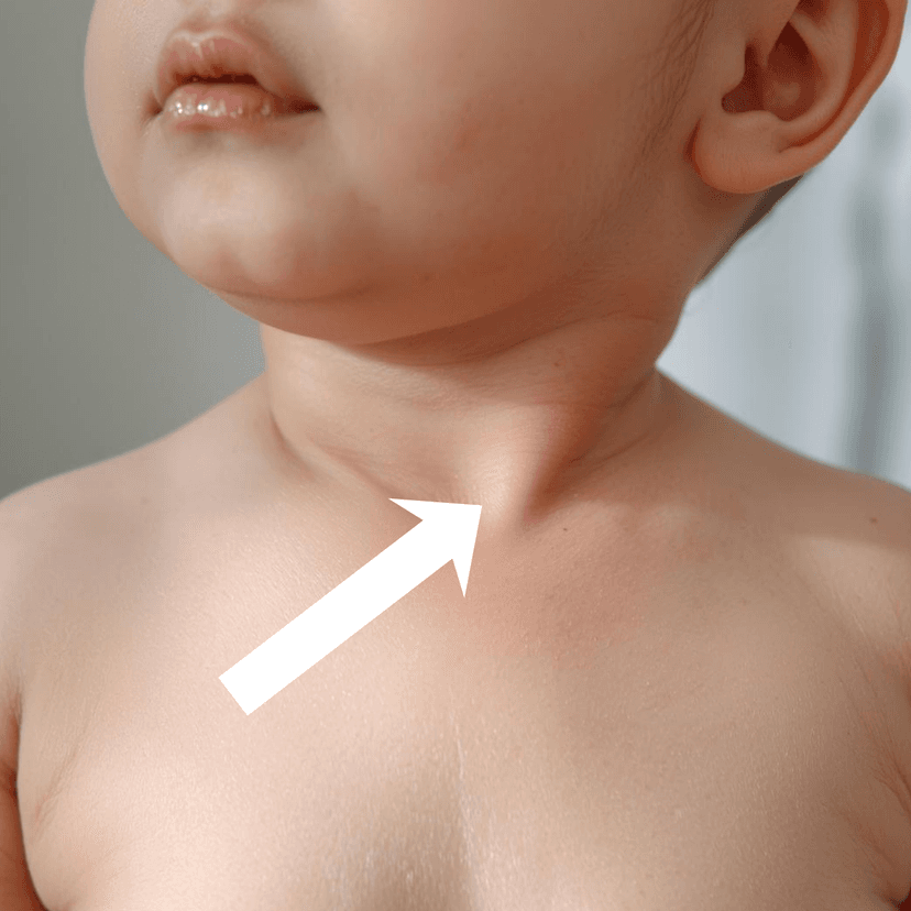 Vue anatomique du muscle sternocléidomastoïdien sur un bébé