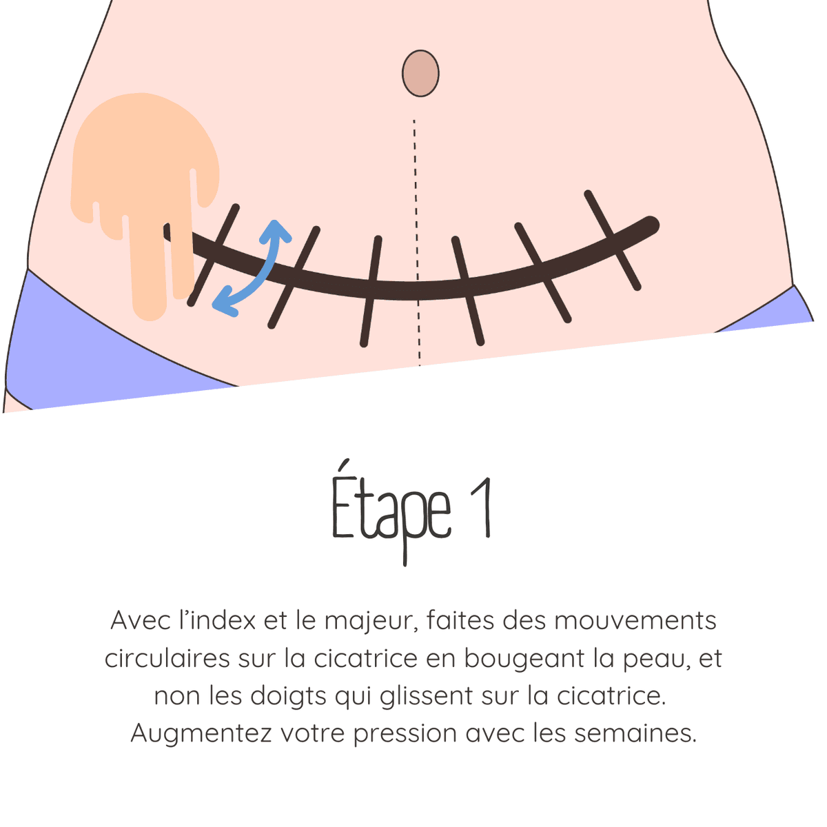 Technique de massage de cicatrice césarienne