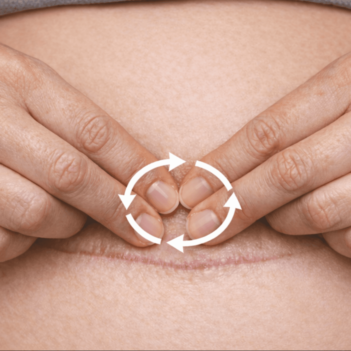 Technique de massage de cicatrice césarienne