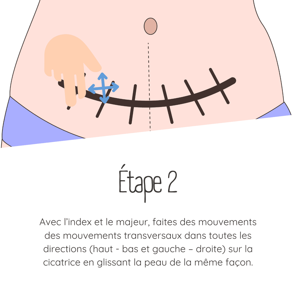 Technique de massage de cicatrice césarienne