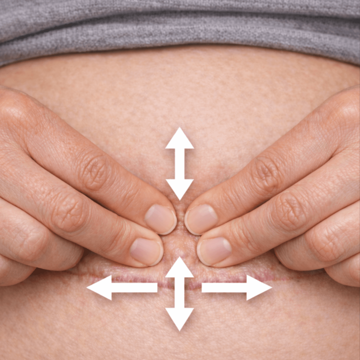 Technique de massage de cicatrice césarienne