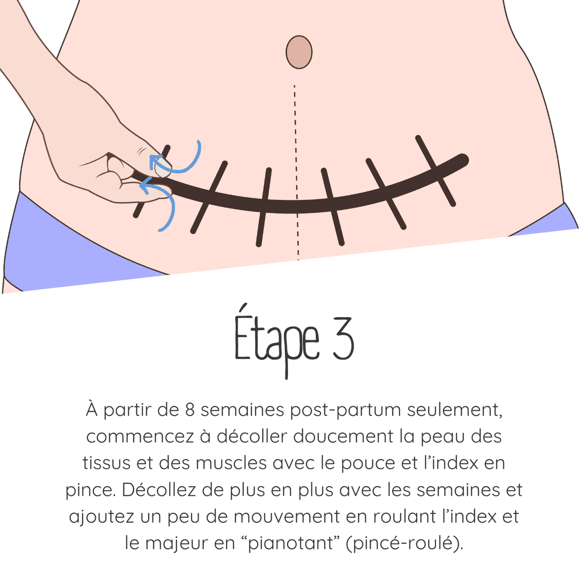 Technique de massage de cicatrice césarienne