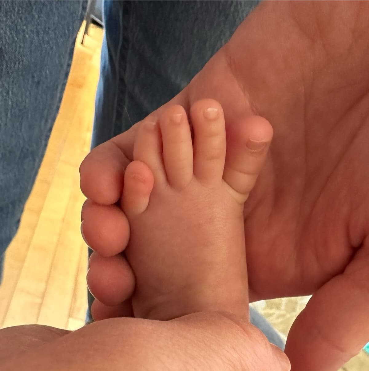 Quintus varus supraadductus - Avant traitement